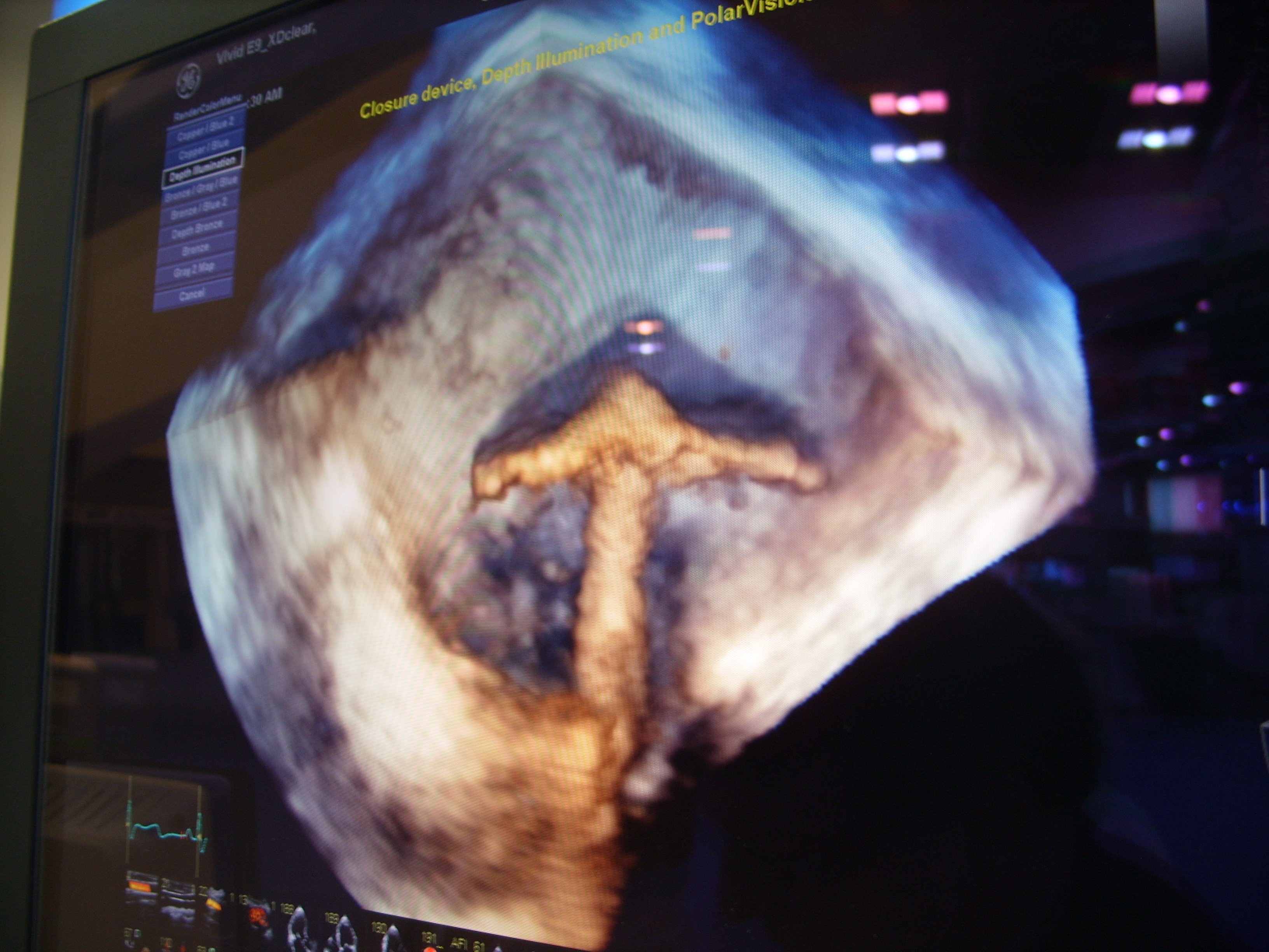 Advances in Transesophageal Echo (TEE) Technology | Imaging